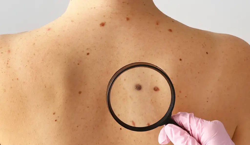 Melanoma pode surgir nos olhos e avançar sem sintomas